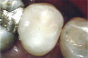 Salisbury tooth fillings